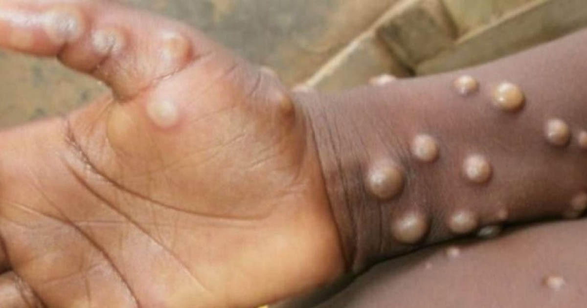 मङ्कीपक्स सङ्क्रमणको जोखिममा नेपाल, कस्तो हुन्छ लक्षण ?